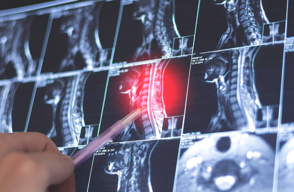 Spinal cord MRI with highlighted pain area